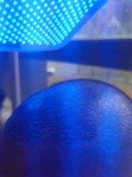 -碧莲盛·不剃发植发