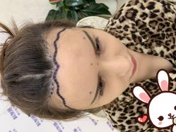 点击看大图 -大麦微针植发丨全国连锁