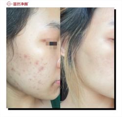 -苗坊净颜痘斑美容护肤连锁