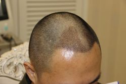 -大麦微针植发全国连锁