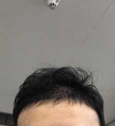 -碧莲盛·不剃发植发