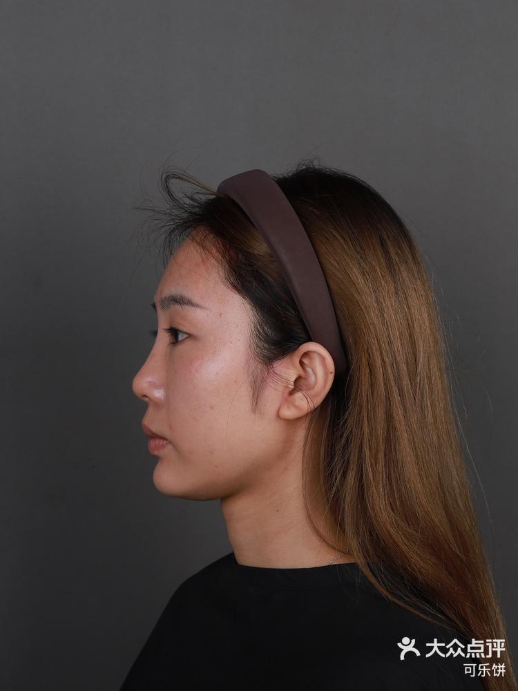 耳软骨鼻综合体验17天后效果分享