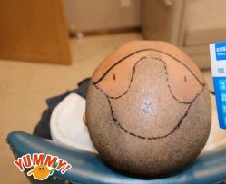 -大麦微针植发全国连锁