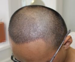 -大麦微针植发全国连锁