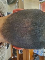 -碧莲盛·不剃发植发