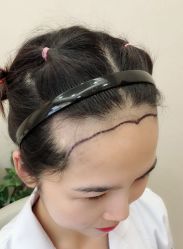 -大麦微针植发全国连锁