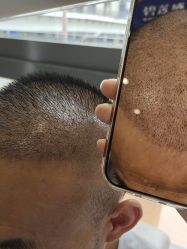 -碧莲盛·不剃发植发