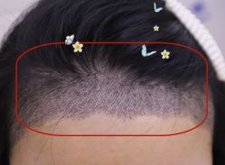 -大麦微针植发全国连锁