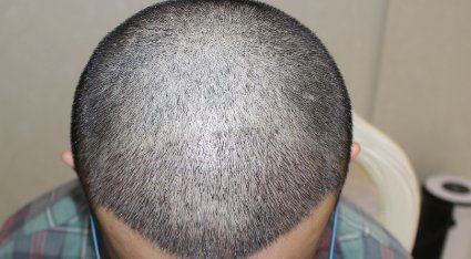 -大麦微针植发全国连锁