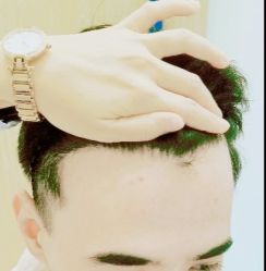 -大麦微针植发丨全国连锁