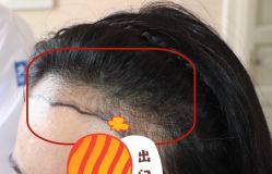 -大麦微针植发全国连锁