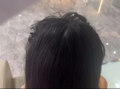 -碧莲盛·不剃发植发