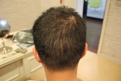 -大麦微针植发丨全国连锁