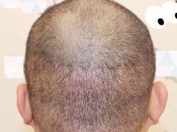 -大麦微针植发全国连锁