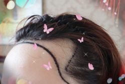 -大麦微针植发全国连锁