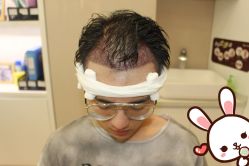 -大麦微针植发丨全国连锁