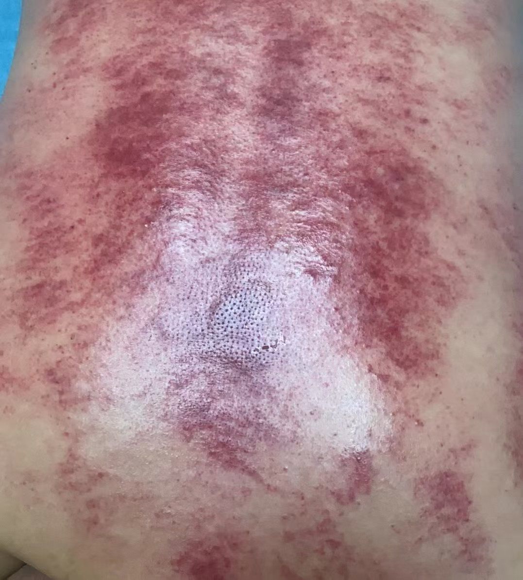 刷经络为什么会起疙瘩