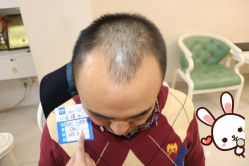 -大麦微针植发丨全国连锁