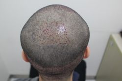 点击看大图 -大麦微针植发丨全国连锁