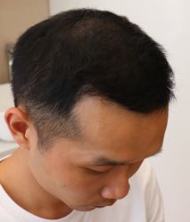 -大麦微针植发全国连锁