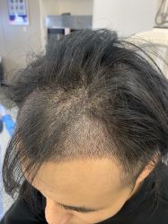 -大麦微针植发全国连锁