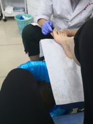 -德哥灰指甲脚气甲沟炎跖疣护理
