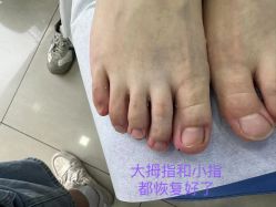 -德哥灰指甲脚气甲沟炎跖疣护理