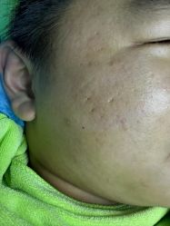 -苗医生0感祛痘连锁