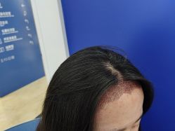 体验后-大麦微针植发全国连锁