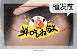 -大麦微针植发全国连锁