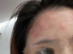 体验后-深圳美莱医疗美容医院