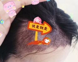 -大麦微针植发全国连锁