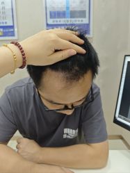 -大麦微针植发丨全国连锁