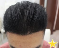 -大麦微针植发丨全国连锁