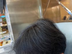-碧莲盛·不剃发植发