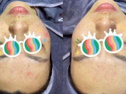 -苗方清颜痘肌研究所