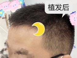 -大麦微针植发全国连锁