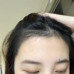 -碧莲盛·不剃发植发