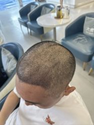 -大麦微针植发全国连锁