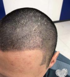 -大麦微针植发丨全国连锁