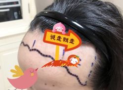 -大麦微针植发全国连锁