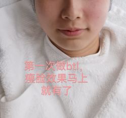 体验后-颜蕾医美黄金微针水光美肤玻尿酸抗衰中心