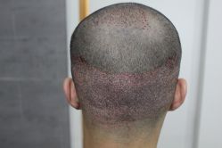 点击看大图 -大麦微针植发丨全国连锁