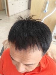 -大麦微针植发丨全国连锁