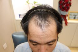 -大麦微针植发丨全国连锁