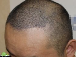 -大麦微针植发丨全国连锁