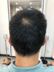 -大麦微针植发全国连锁