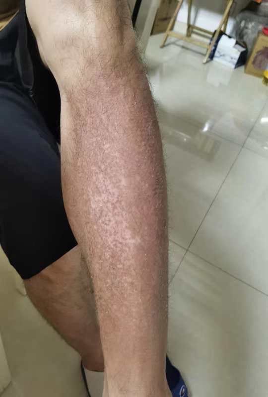 集拼图记生活腿上电暖灯烤伤,现在干巴巴