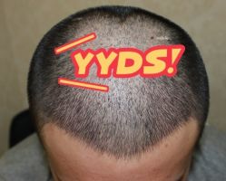 -大麦微针植发丨全国连锁