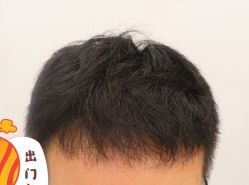 -大麦微针植发全国连锁